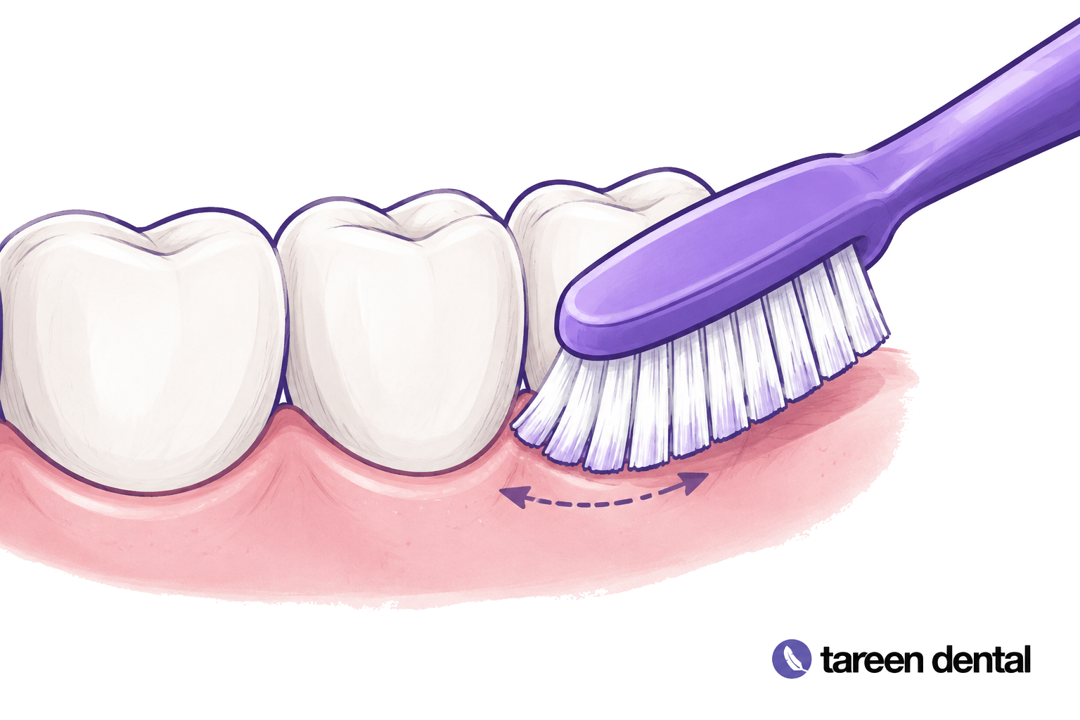 Soft toothbrush at the gumline of a dental teaching model.