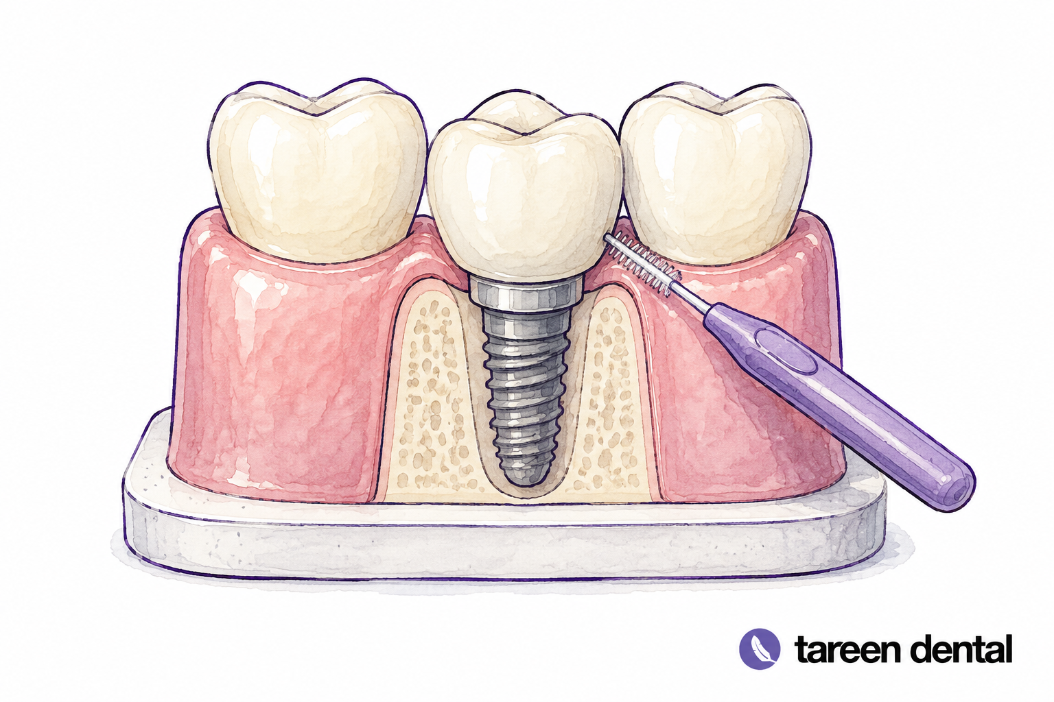 Implant restoration model with cleaning tools.