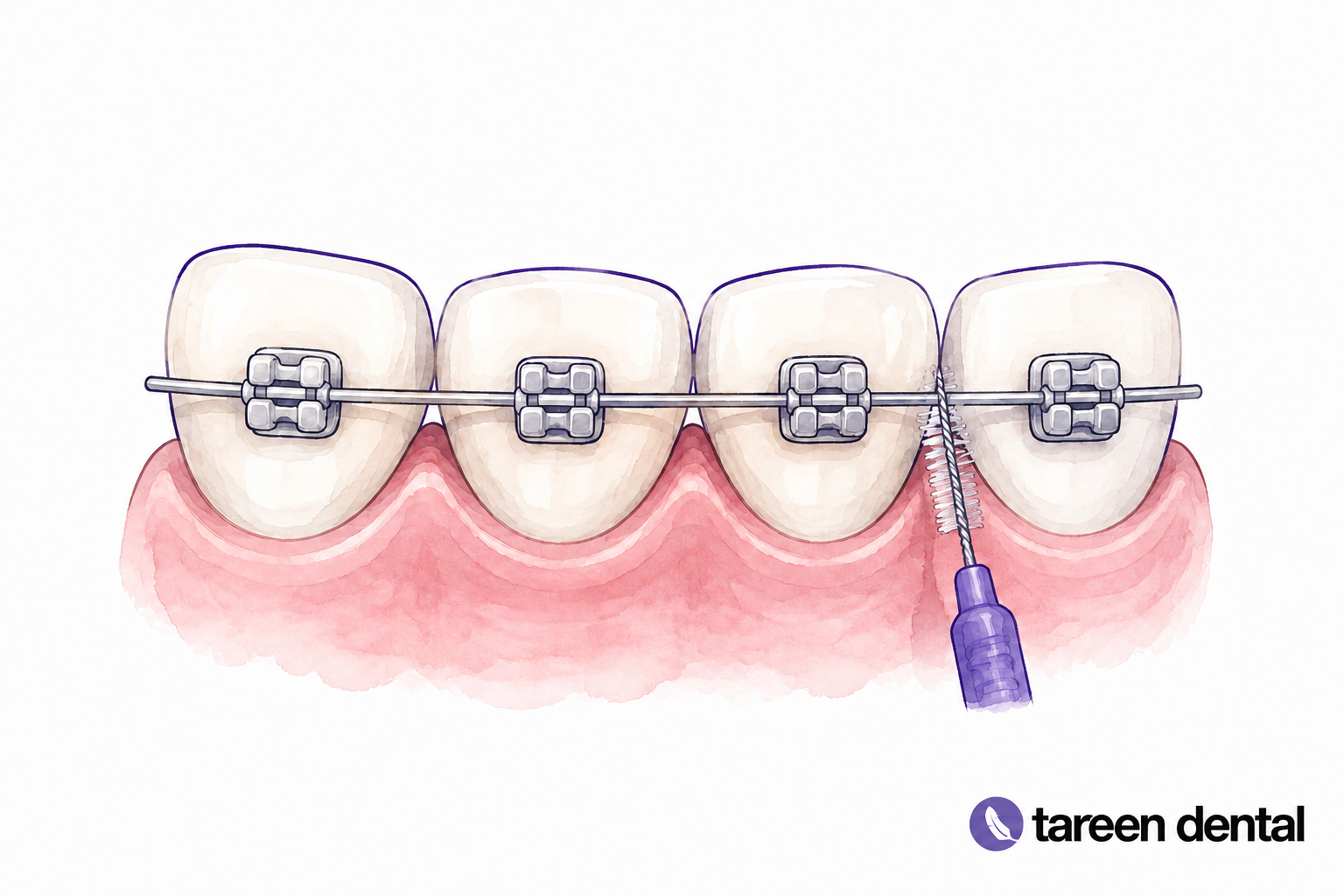 Four model teeth with braces and a small interdental brush.
