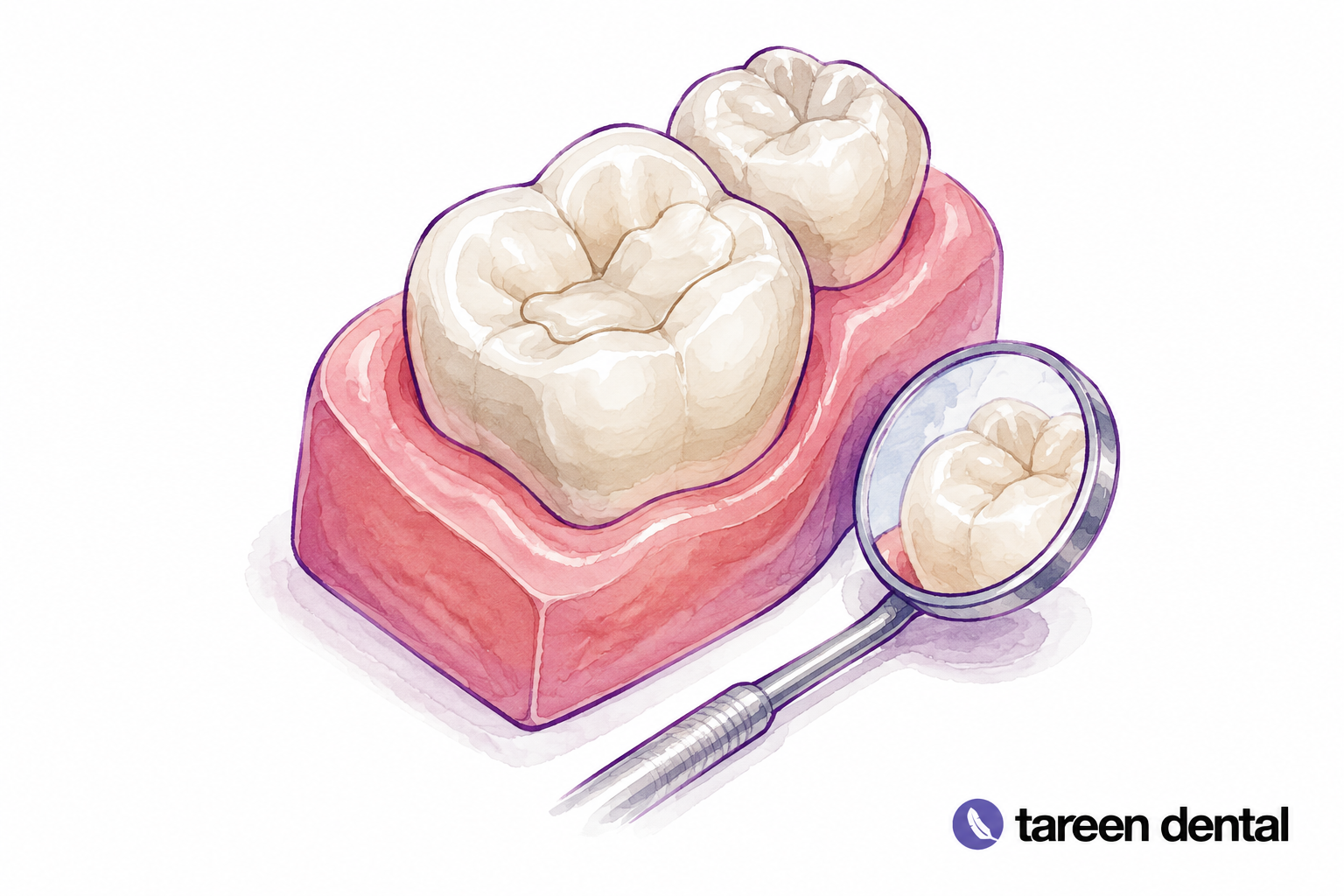 Molar model with a tooth-coloured filling and dental mirror.