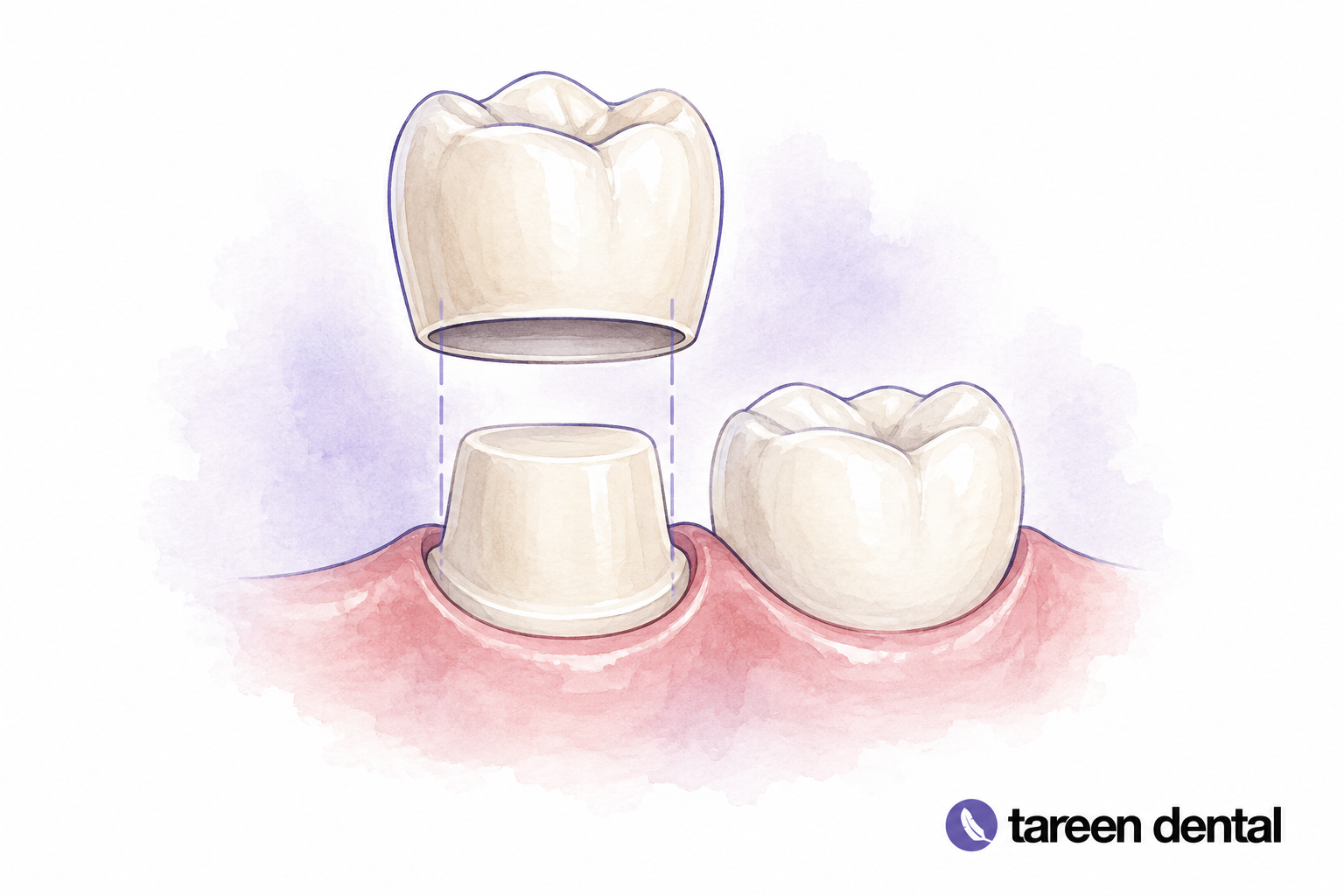 Porcelain crown above a prepared tooth model.