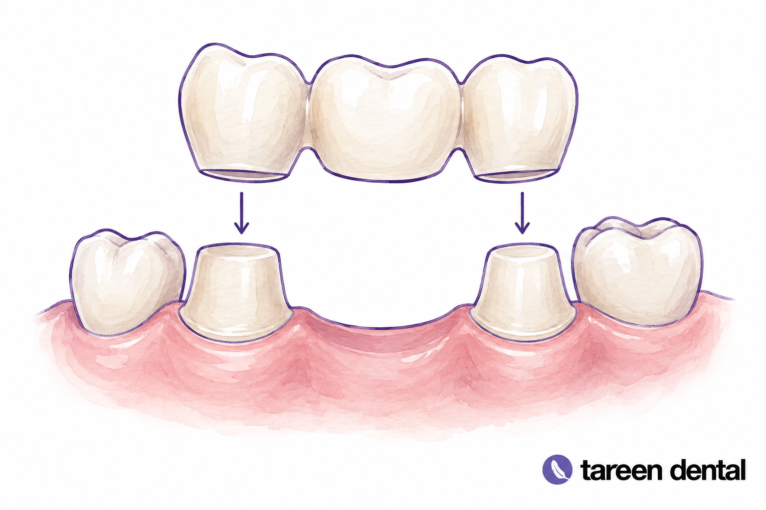Dental bridge model showing a replacement tooth supported by neighbouring teeth.