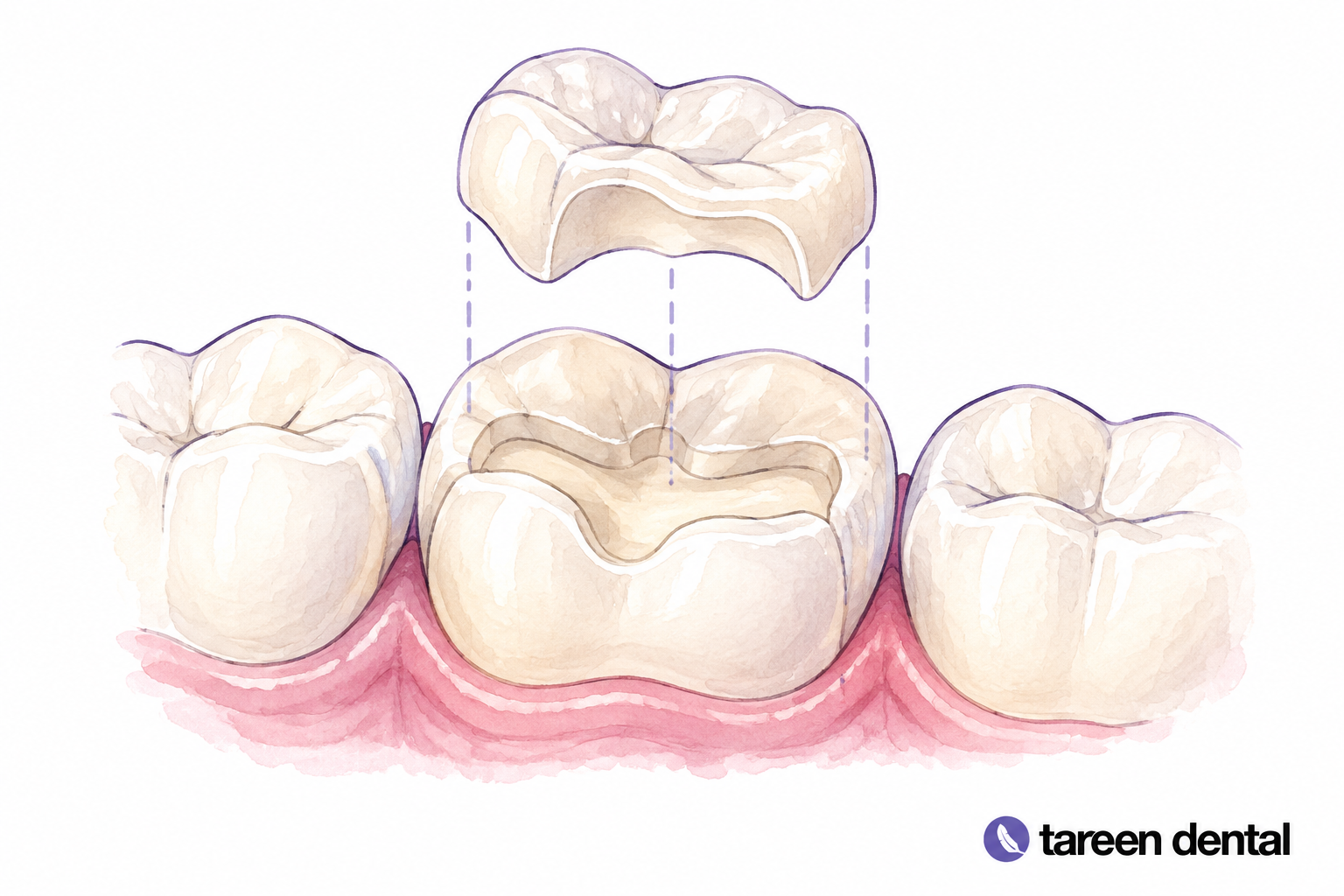 Tooth model with a fitted partial-coverage onlay restoration.