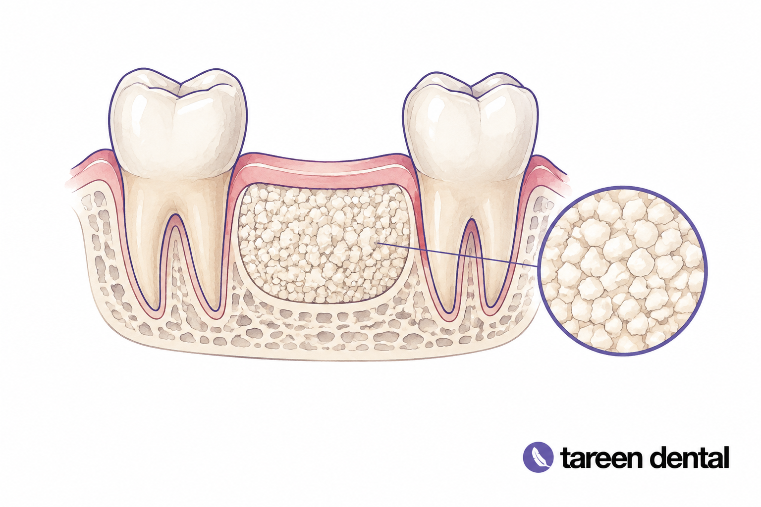 Dental model illustrating a bone graft site.