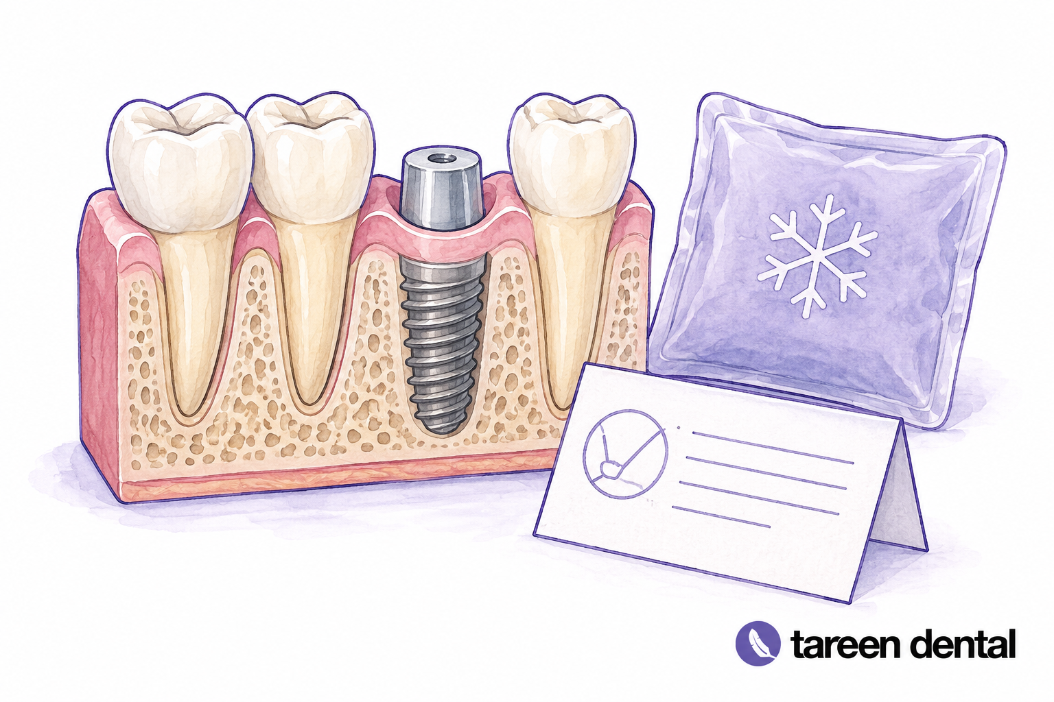 Single dental implant model with its connecting component and crown.