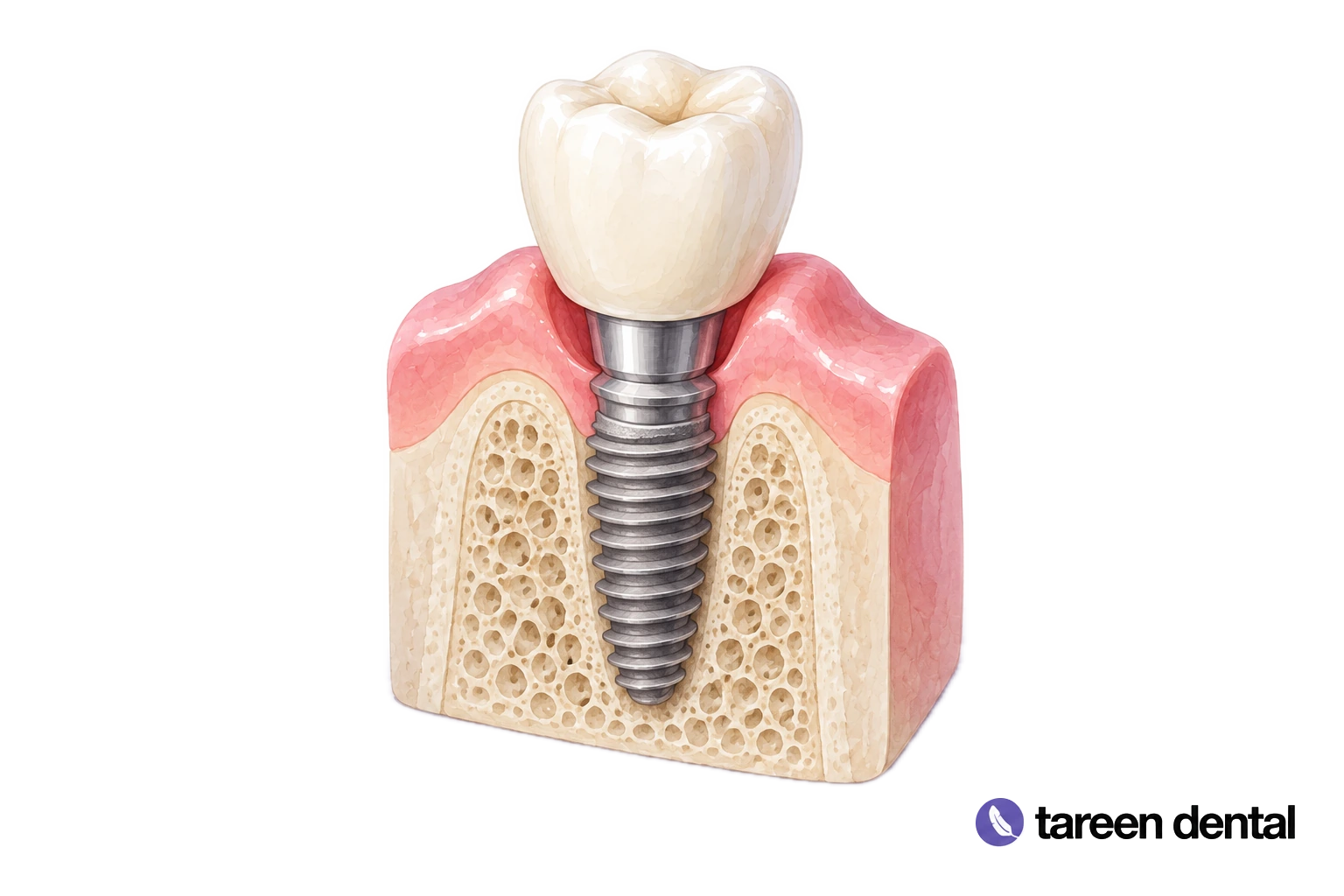 Watercolor cutaway model showing a dental implant supporting a crown in bone