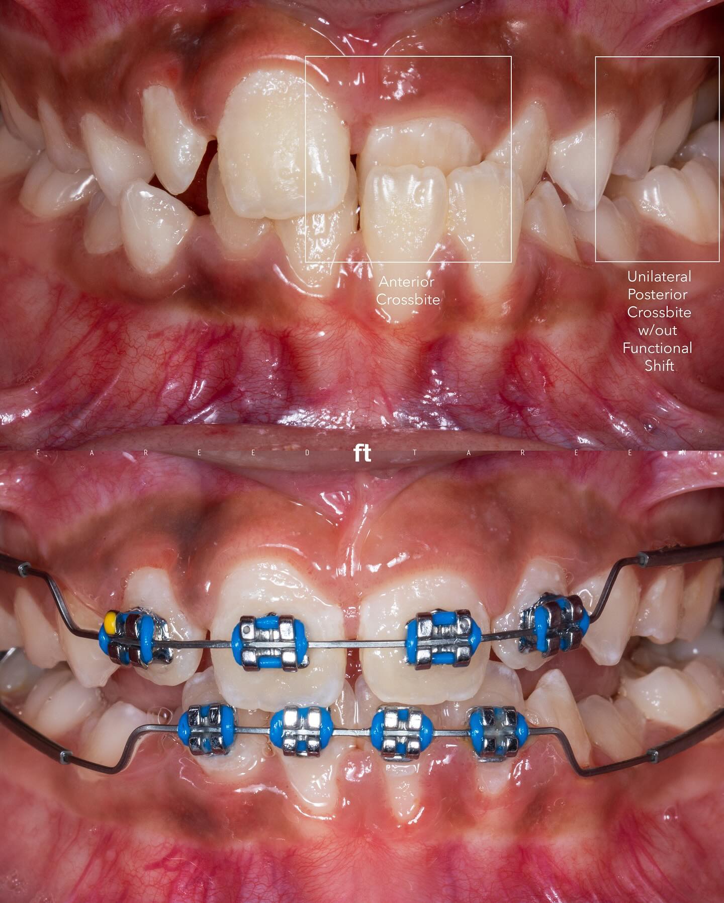 Original comparison labelled anterior and unilateral posterior crossbite above, with a later view during braces treatment below.