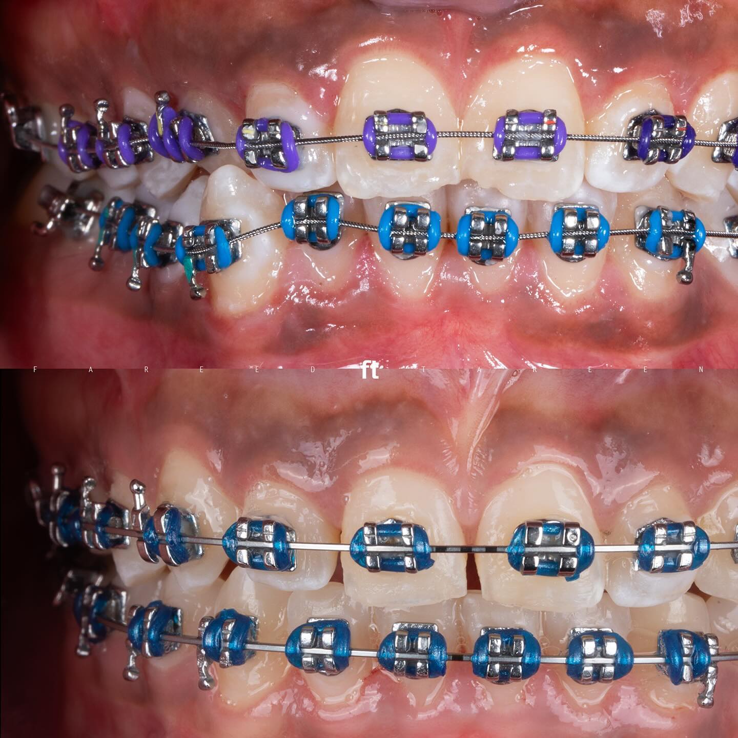 Two original front-tooth views during fixed-braces treatment, with braces in both panels and FT attribution retained.