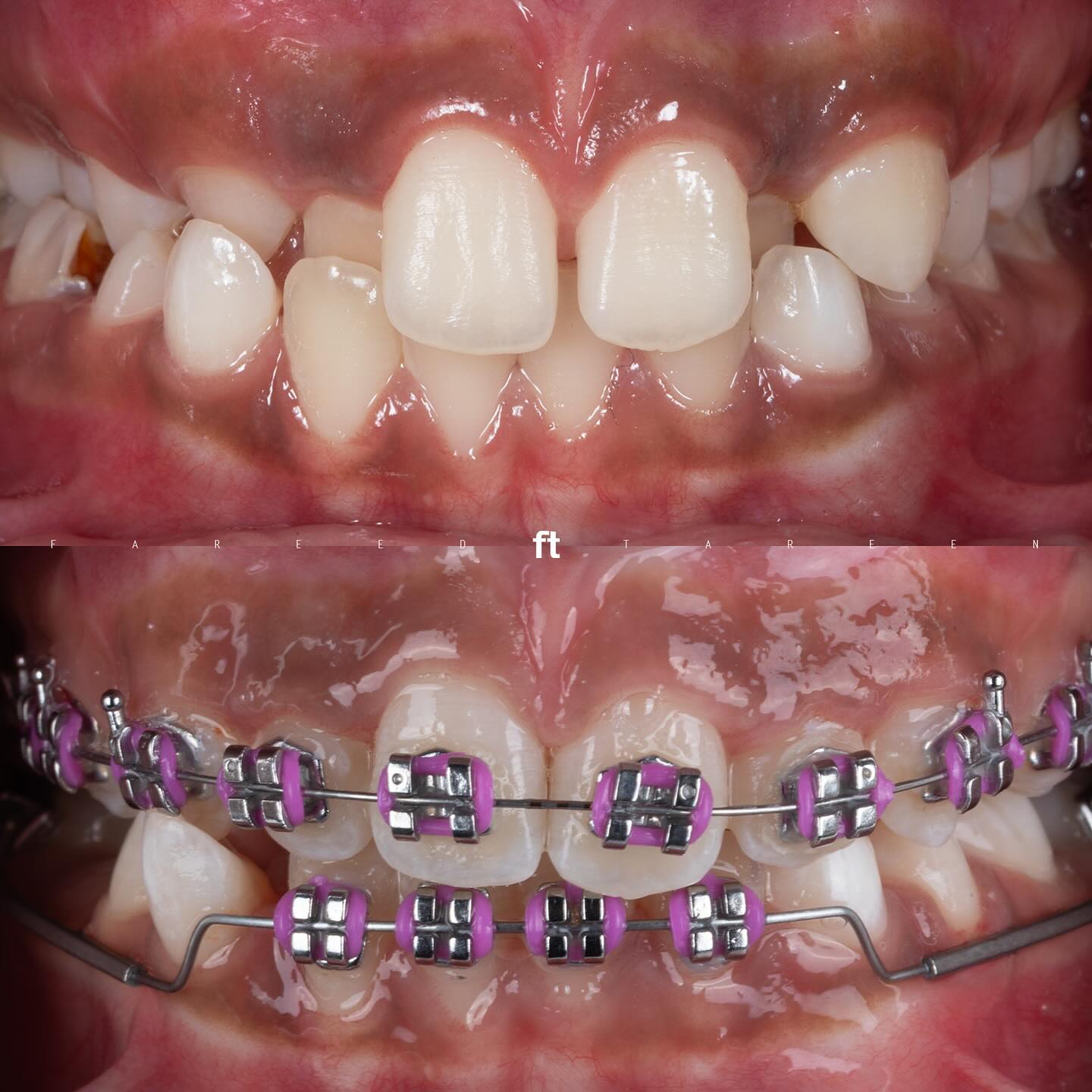 Original paired photographs: front teeth before treatment above and a progress view with purple braces below; FT attribution retained.