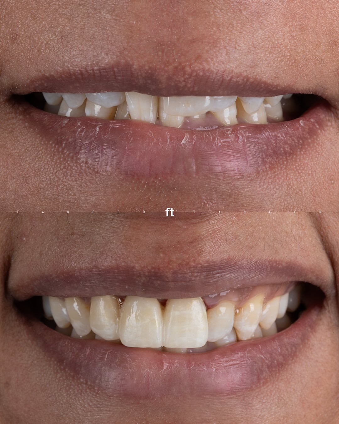 Upper three-unit bridge comparison with the earlier smile above and insertion-day smile below.