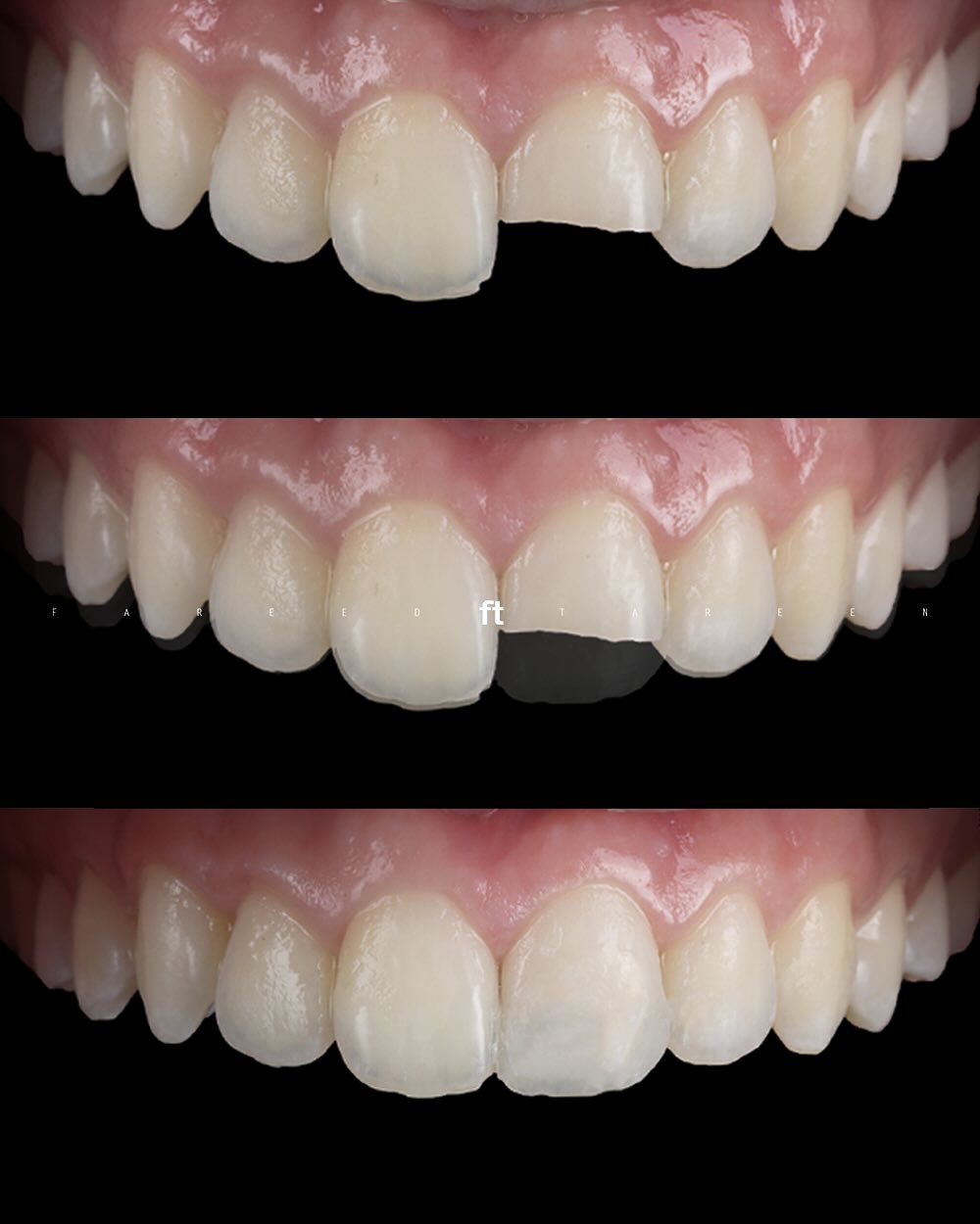 Three-panel front-tooth repair sequence: chipped edge above, intermediate overlay in the middle, completed composite repair below.