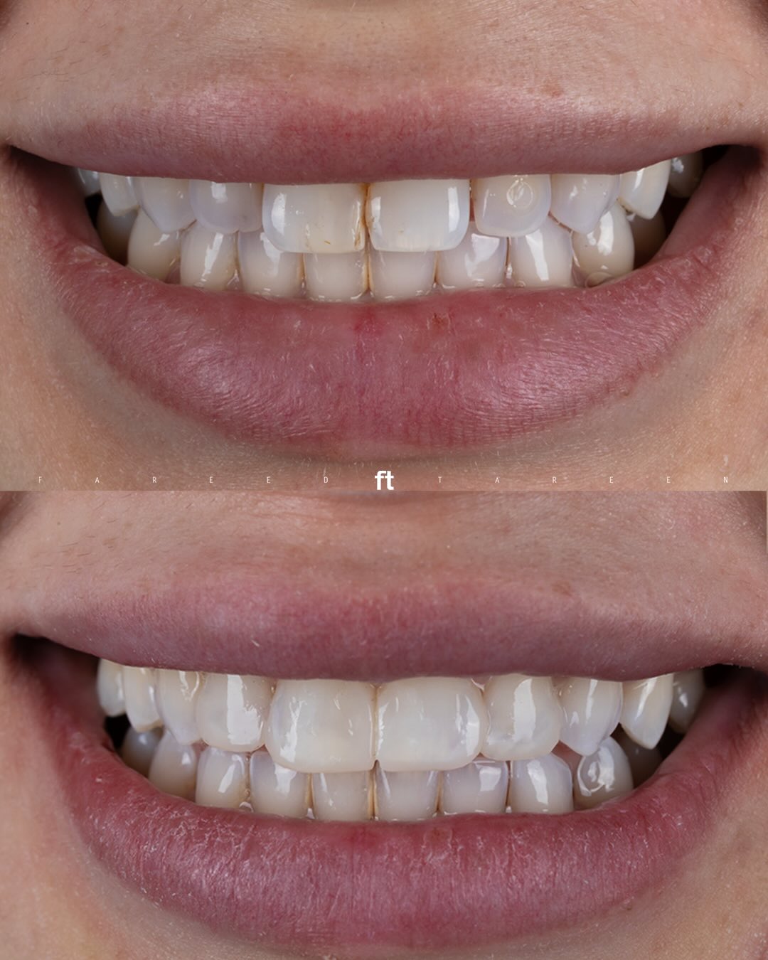 Front-tooth composite restoration comparison, with the earlier smile above and the later smile below.