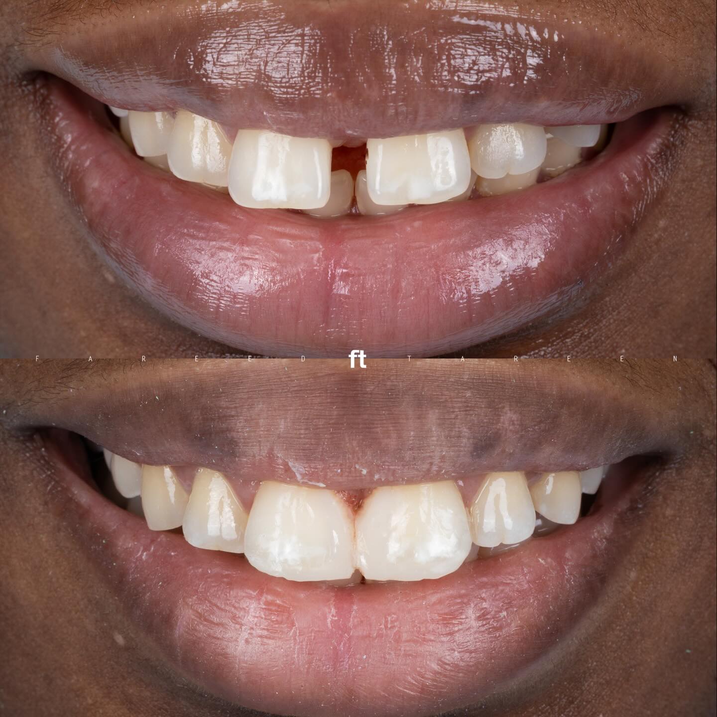 Before and after composite closure of a gap between the upper front teeth; before above and after below.