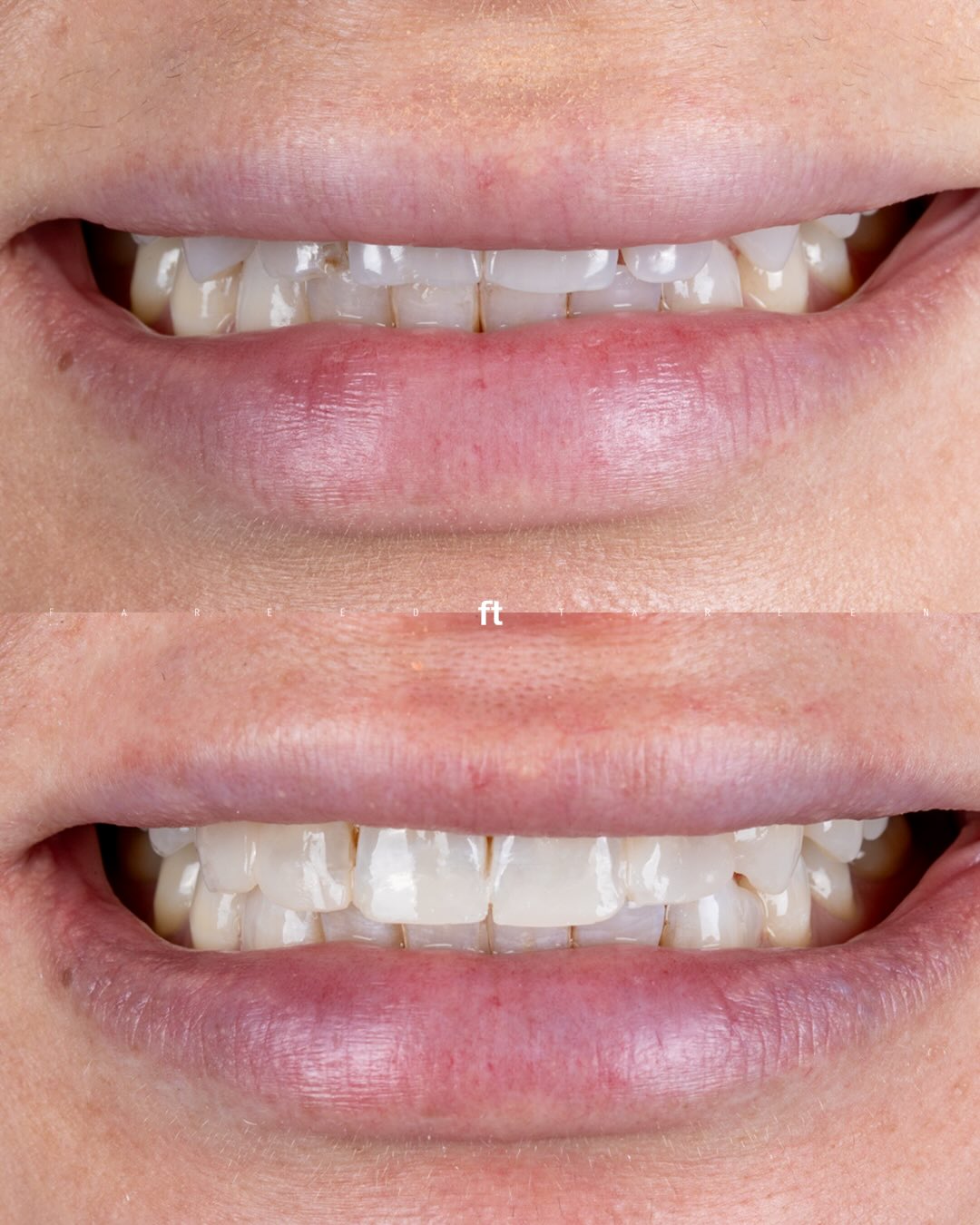 Two smile views showing the front-tooth edges and spacing before and after composite restorations.