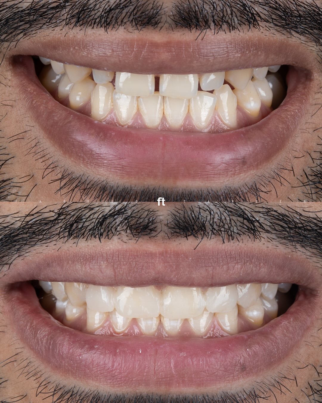 Two smile photographs from a composite smile-design case, before above and after below; original FT watermark retained.