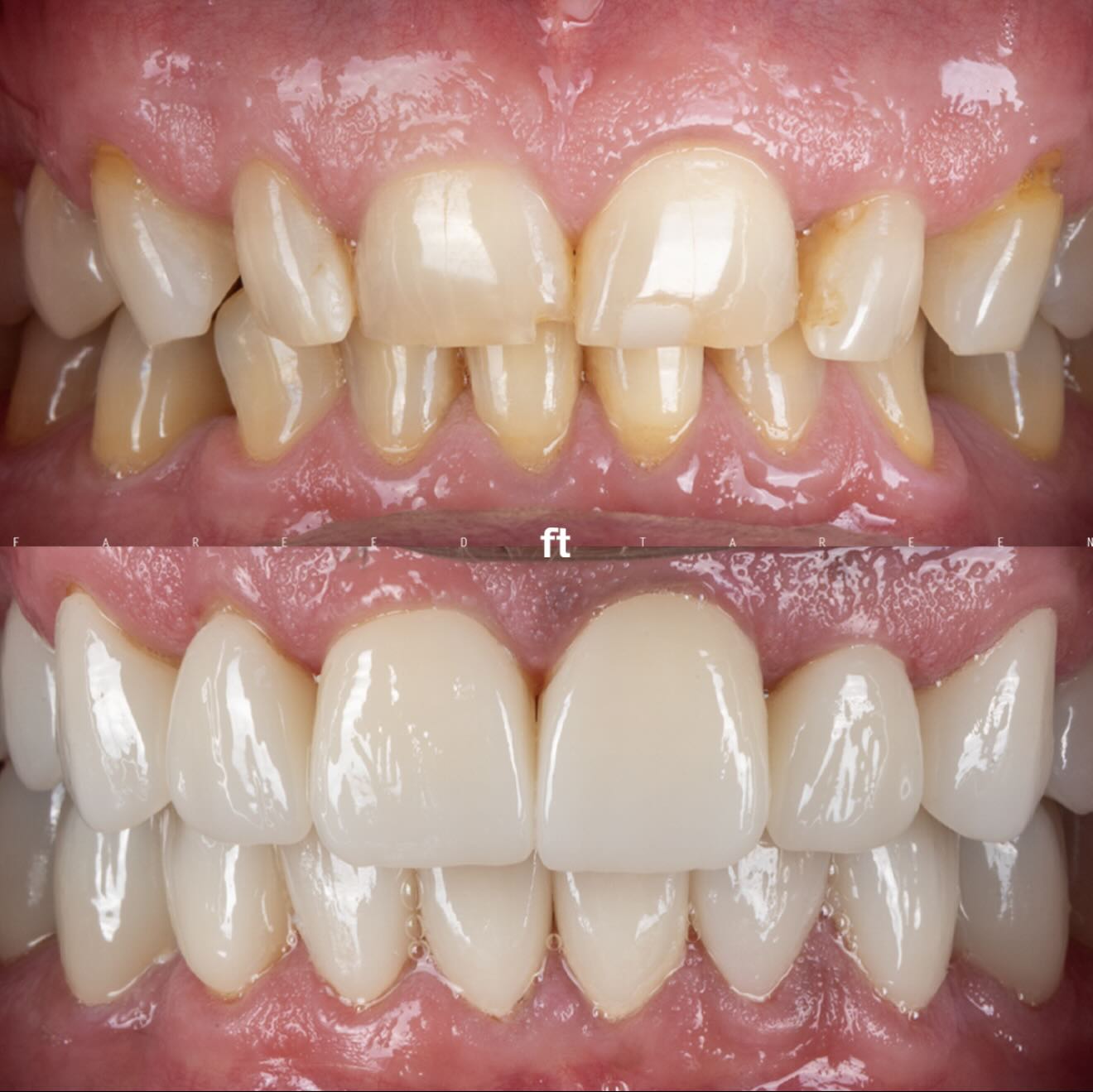 Rehabilitation comparison showing teeth before treatment above and immediately after insertion below.