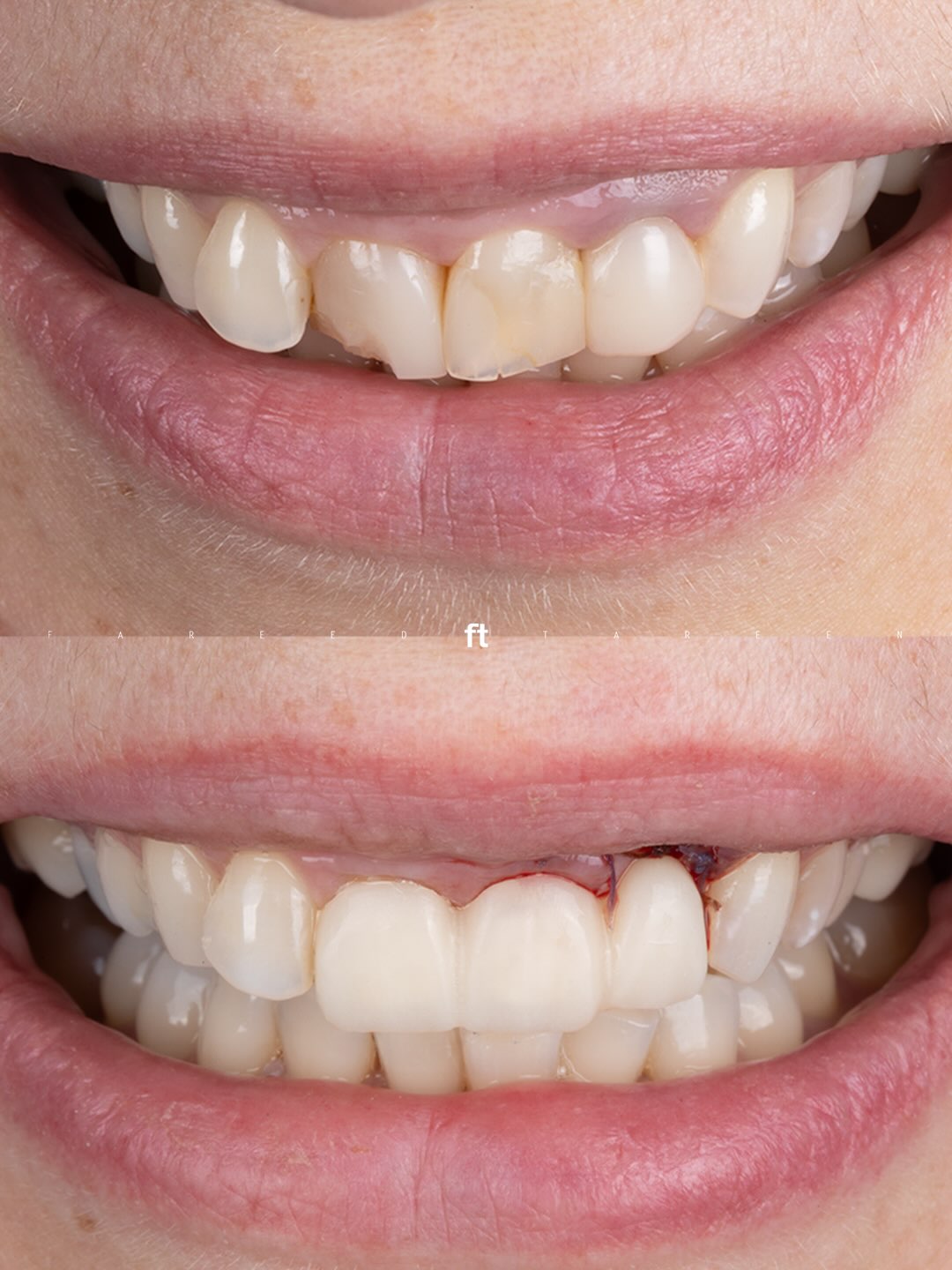 Two smile views from a case described as phase one of restorative and surgical care.